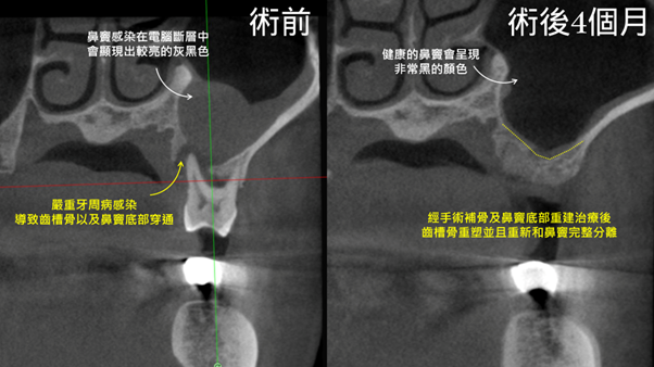 (本文附圖為實際案例之3D電腦斷層影像，左圖為術前可見明顯的骨頭缺損與鼻竇感染；右圖為術後4個月，可見骨頭已成功重建，鼻竇恢復健康狀態。)
