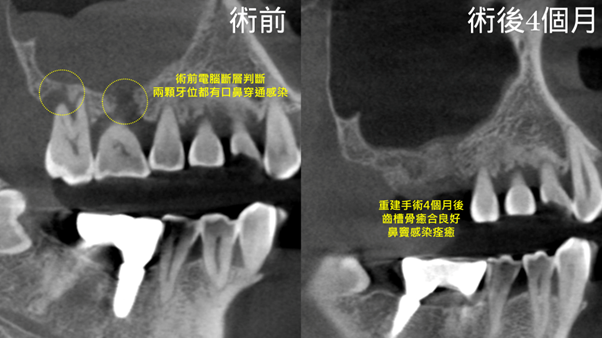 (X光影像對比圖)