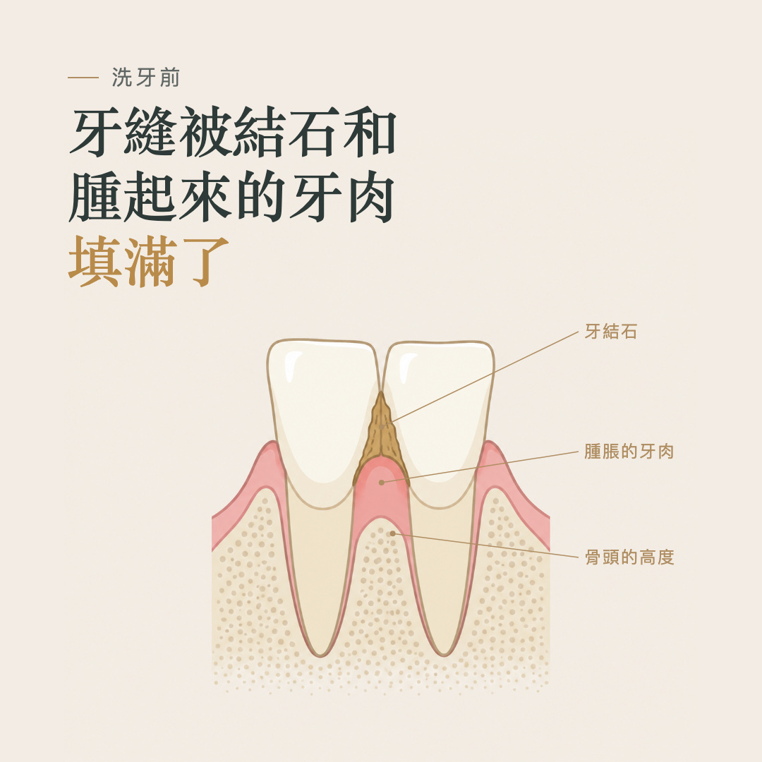 洗牙前